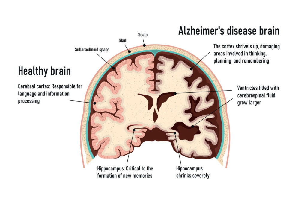 Graphical cross section of brain showing a healthy brain compared to one with Alzheimer's disease.